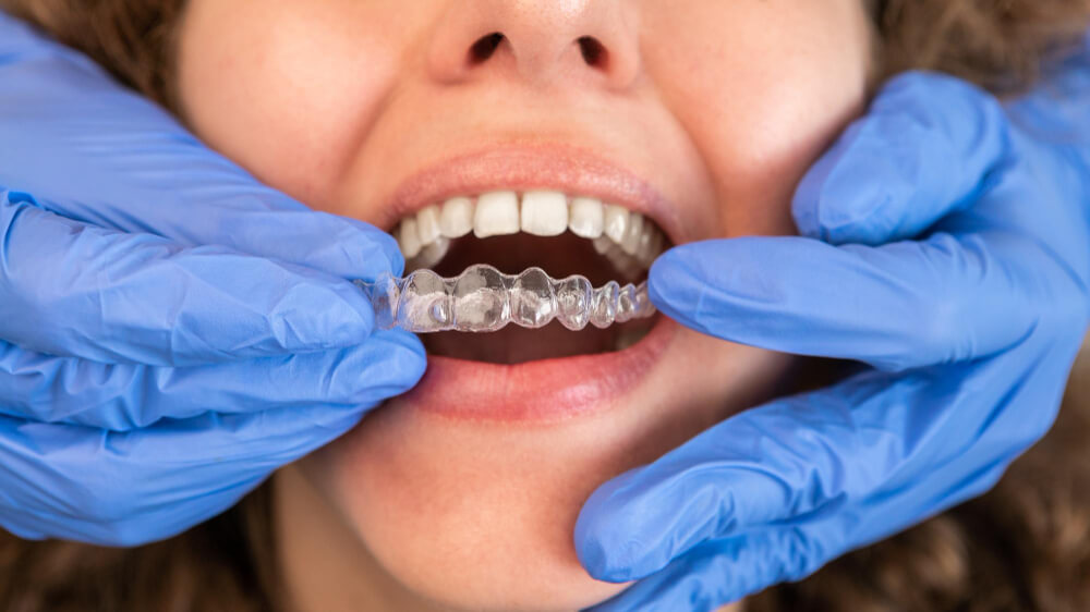 invisalign-merubah-bentuk-rahang-dan-wajah