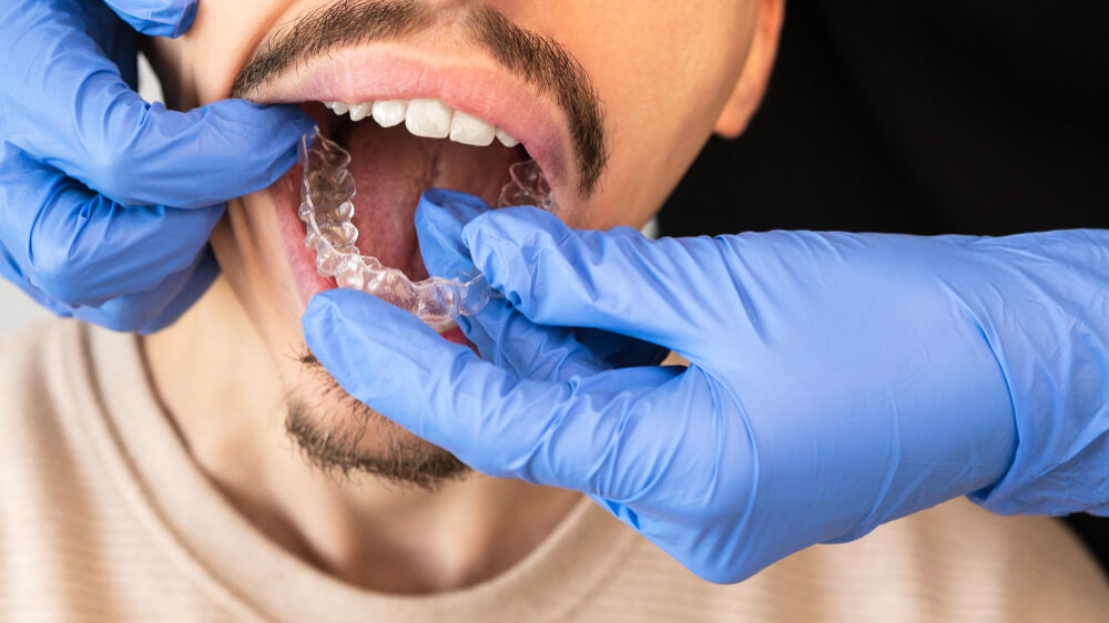 invisalign-untuk-pasien-dengan-crown